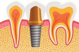 dental implant in lancaster - dental implant image